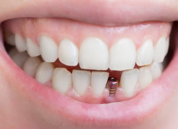 Smile with dental implant