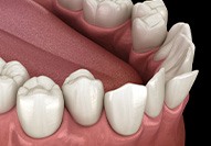 Illustration of crowded teeth