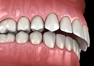 Illustration of an overbite