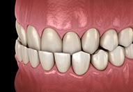 Illustration of an underbite