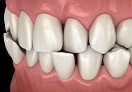 Illustration of a crossbite