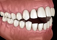 Illustration of an open bite