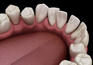 3D illustration of crooked teeth