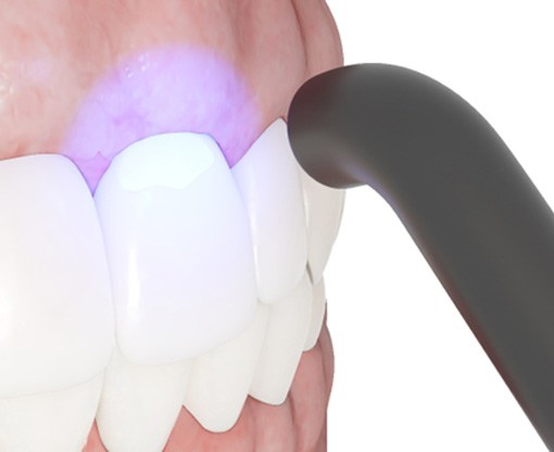 an illustration of the dental bonding process