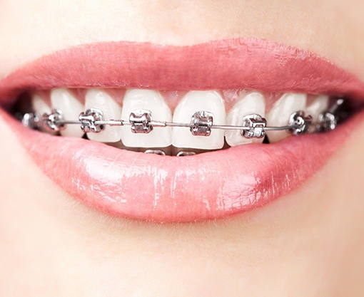 A close-up of teeth with metal braces