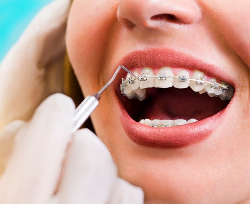 An orthodontist checking a woman’s braces