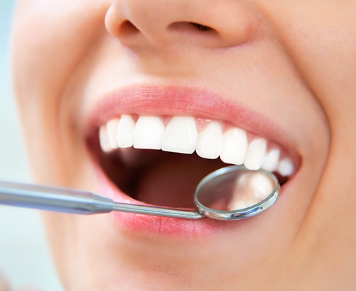 Closeup of smile with tooth-colored fillings