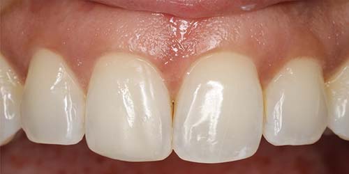 Before treatment