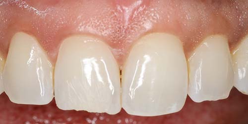 Before treatment