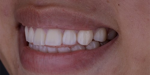 Before treatment