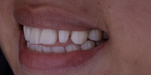 Before treatment