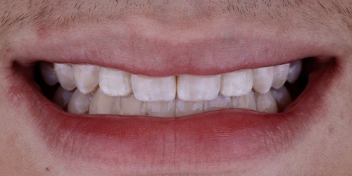 Before treatment