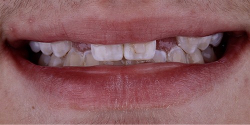 Before treatment