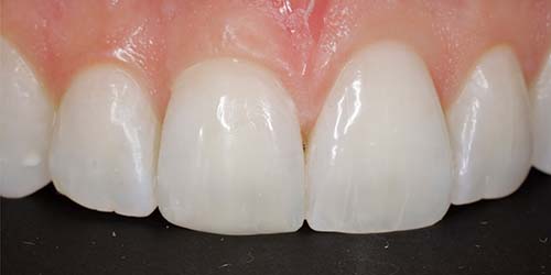 Before treatment