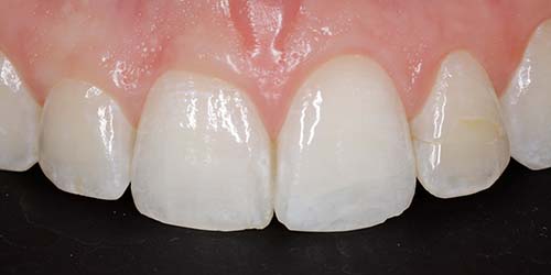 Before treatment