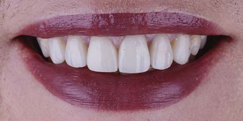 Before treatment