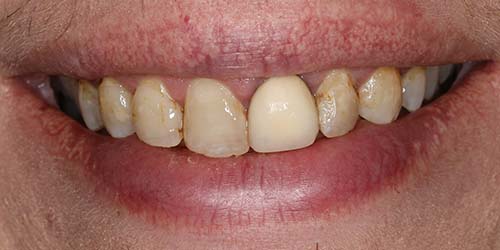 Before treatment