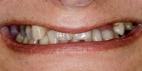 Before treatment