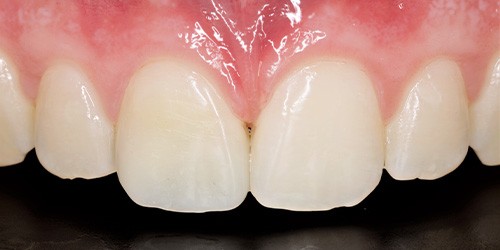 Before treatment