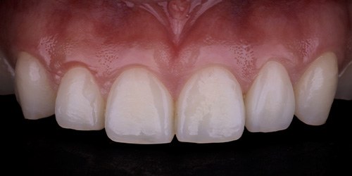Before treatment