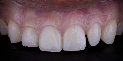 Before treatment