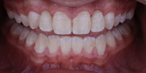 Before treatment