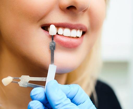 Smile compared with tooth color chart