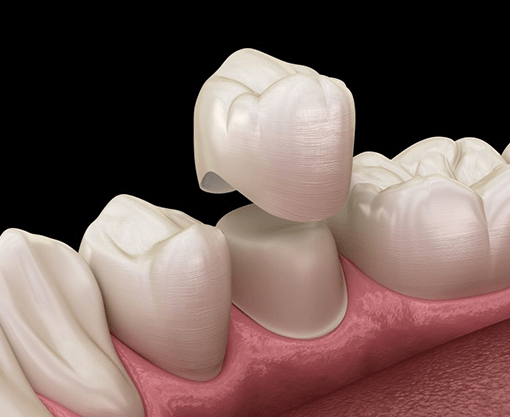 a 3D digital illustration of a dental crown