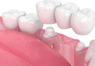 Illustration showing how a dental bridge fits over abutments
