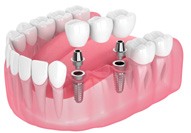 Illustration demonstrating how a bridge connects to dental implants