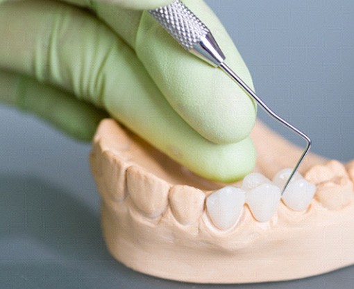 Sample dental bridge on a model lower arch