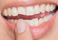 Closeup of smile with chipped front tooth