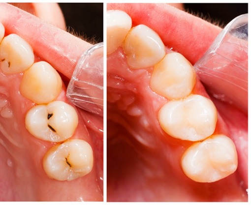 Before and after image of teeth repaired with tooth-colored fillings in Carmel, IN