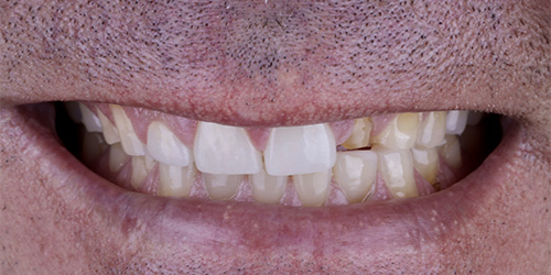 Before treatment