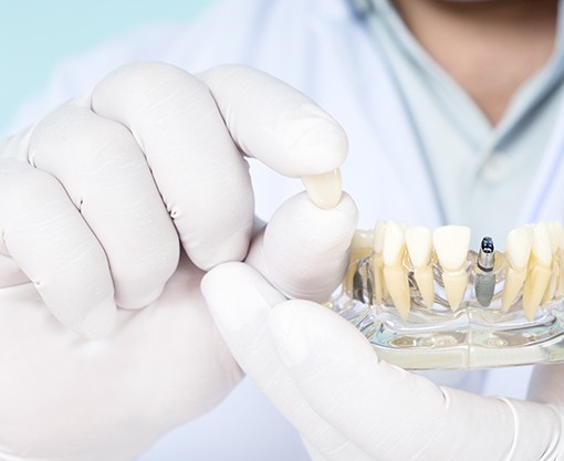 Closeup of dentist wearing white holding sample dental implant