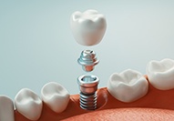 3D rendering of the parts of a dental implant levitating above lower arch of teeth
