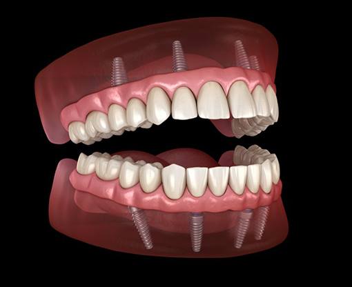 Illustration of implant dentures in gum tissue
