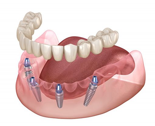Illustration of removable denture