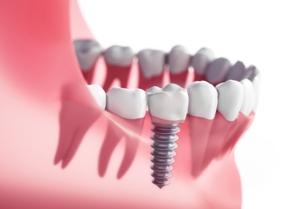 3D animation of implant supported dental crown