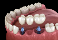 Animation of implant supported fixed bridge