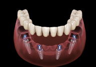 Animation of implant supported denture