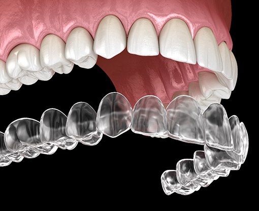 3D illustration of Invisalign and upper teeth  