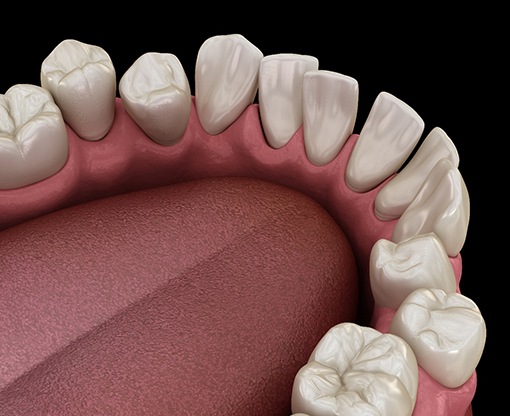 3D illustration of crooked teeth  