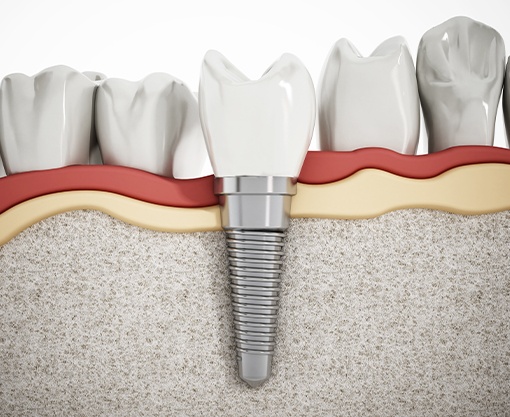 Animation of implant supported dental crown