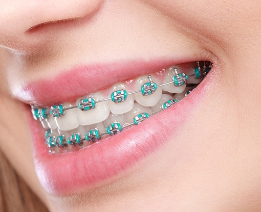 Mouth with traditional braces in Carmel