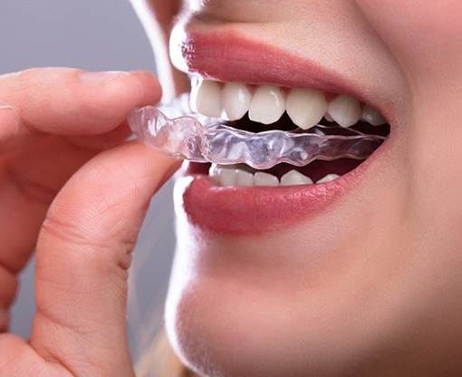 Patient wearing clear aligners in Carmel