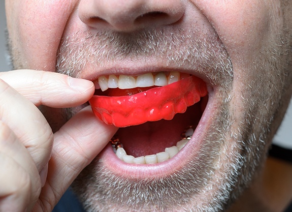 Closeup of man placing athletic mouthguard