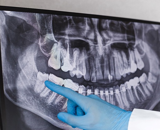 A dentist pointing to a wisdom tooth in an X-ray
