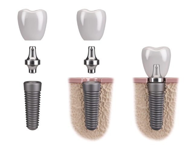 An image of a dental implant, abutment and crown
