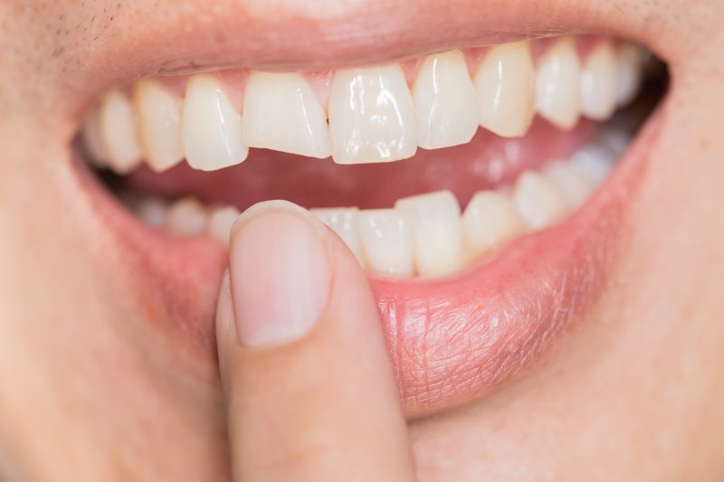 A cracked or broken tooth, one of the most common cosmetic dental flaws in Carmel